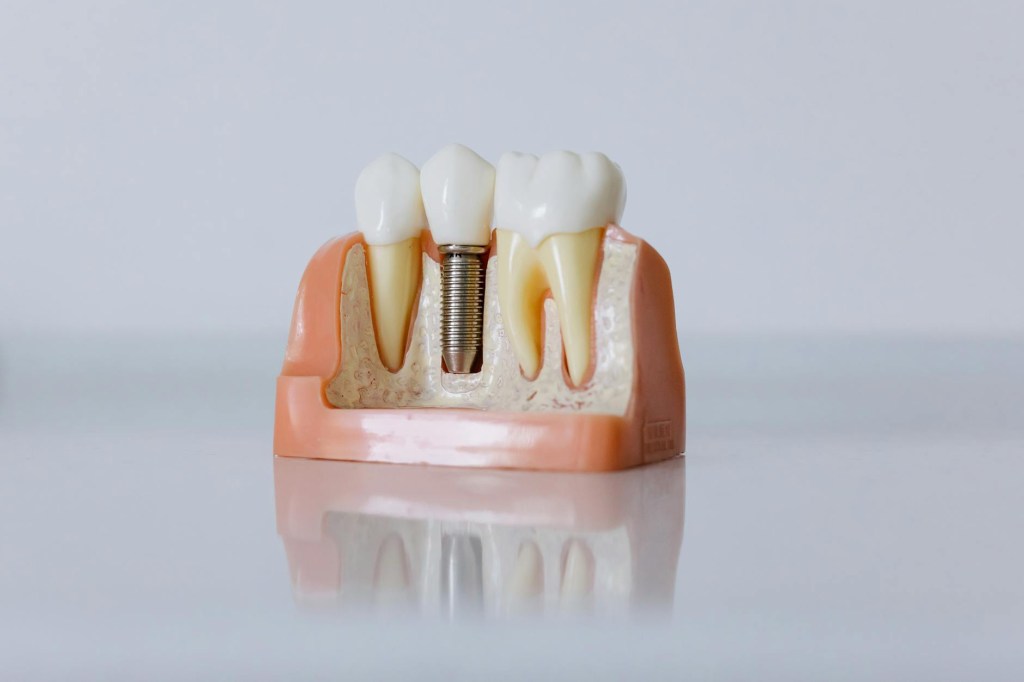 Dê um UP no Seu Sorriso! Confira Nossas Opções de&nbsp;Implantes